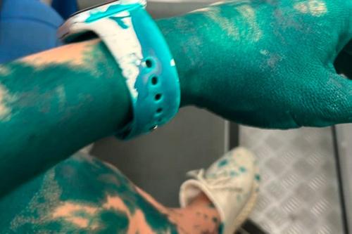 Адвокат Елена Пономарева, которую в Москве на остановке облили зеленкой, получила ожог глаз второй степени Адвокат Елена Пономарева, которую в Москве на остановке облили зеленкой, получила ожог глаз второй степени