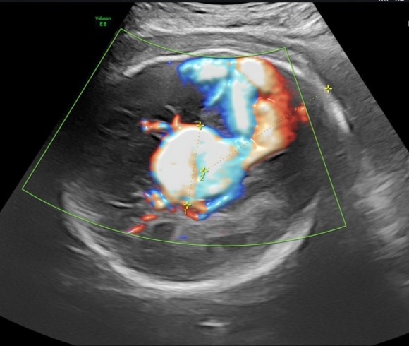 Уральские врачи первыми в России и вторыми в мире сделали внутриутробную операцию на кровеносном сосуде головного мозга