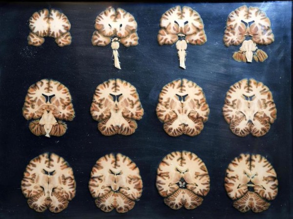 Новые исследования показали возрастание рисков для мозга при занятиях спортом